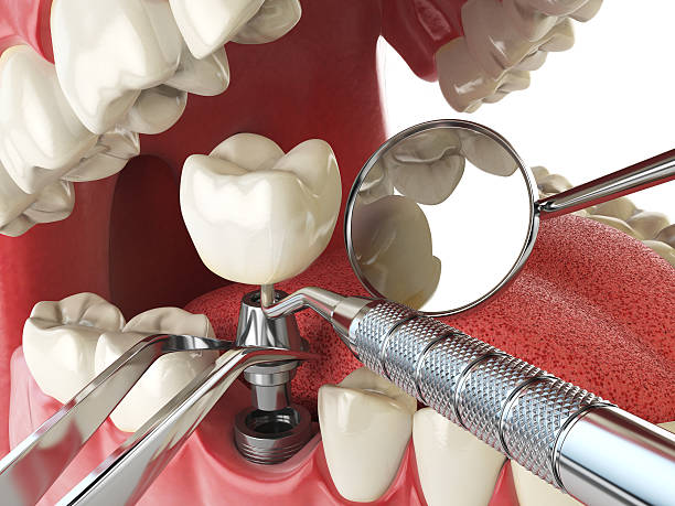 Best Emergency Treatment for Oral Infections in Keeseville, NY